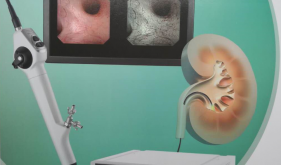科室品牌與特色：泌尿系結石的微創治療—輸尿管軟鏡技術