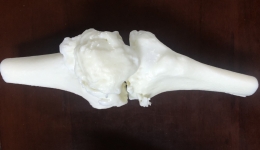 3D打印技術重塑患者“膝”望七旬老人感慨太神奇 ——我院成功完成一例3D打印復雜膝關節置換手術