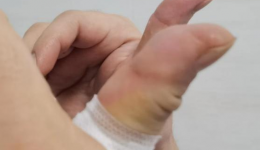 终于竖起了“点赞”的大拇指  ——湖医附一医院中医一招治愈腱鞘炎