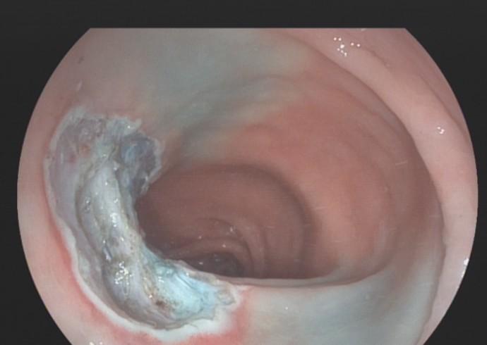 乙状结肠息肉esd术开展新技术——粘膜下剥离术(esd)科室拥有胃镜室